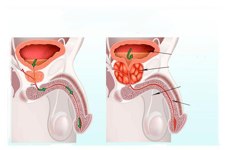 norm and inflammation of the prostate