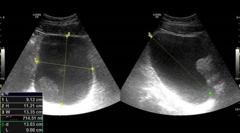 signs of prostatitis on ultrasound